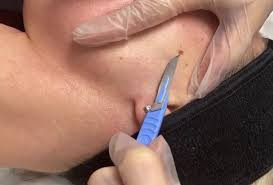 Express Dermaplanning